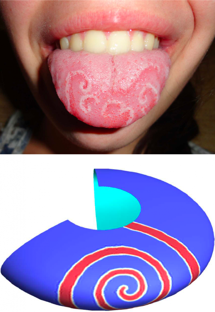 Geographic tongue example